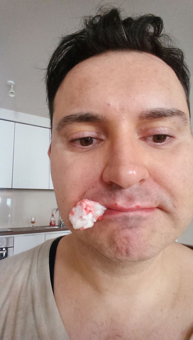 Michał Witkowski wstrzykuje sobie botoks i powiększa usta!