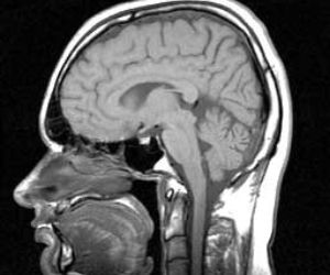 Schizofrenia - 2