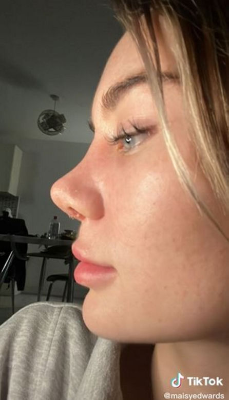 Znana influencerka pojechała do Turcji "zrobić" sobie nos. Wydała 50 tys. zł, fani bezlitośni: "Jest gorzej"