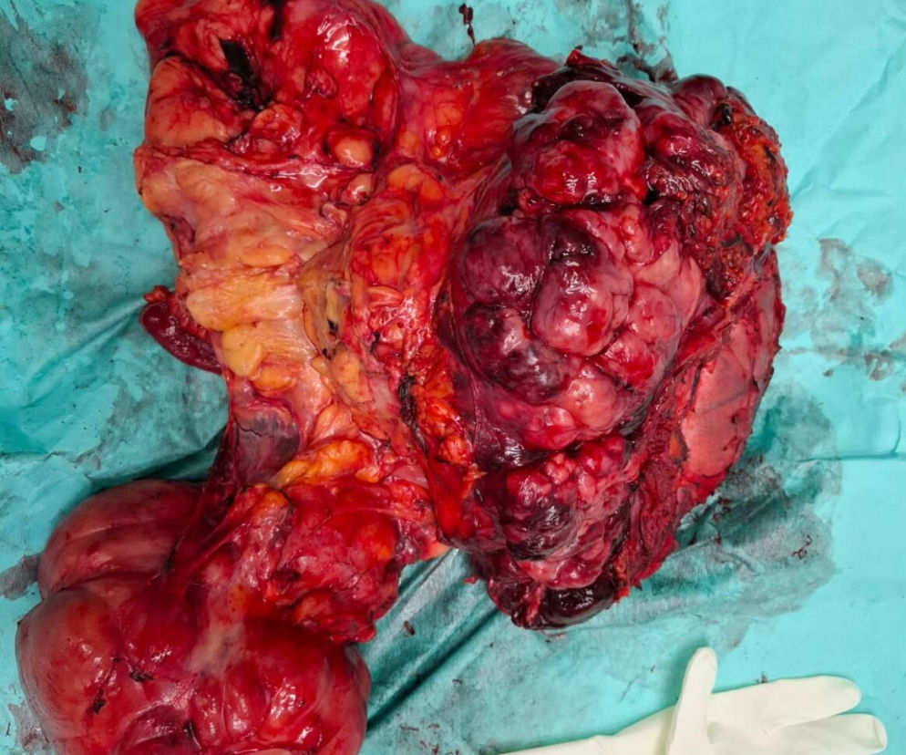 Sosnowieccy lekarze wycięli wielkiego guza