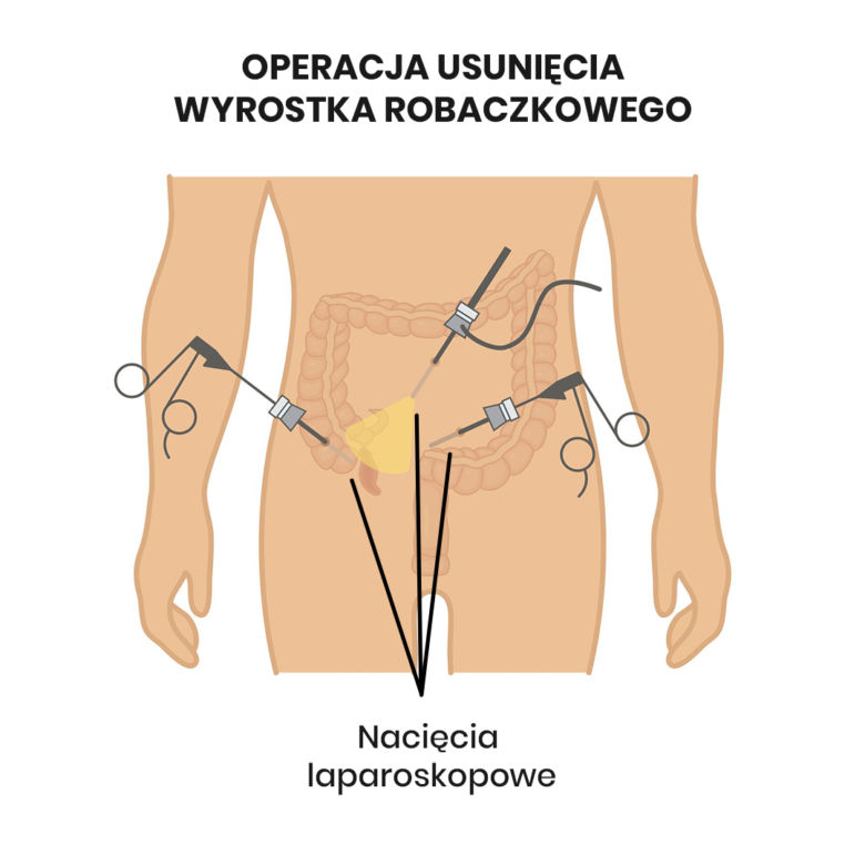 Schemat laparoskopowego usunięcia wyrostka robaczkowego