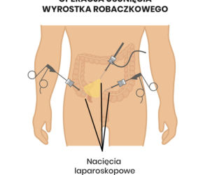 Schemat laparoskopowego usunięcia wyrostka robaczkowego