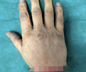 Wojciech Różycki stracił dłoń