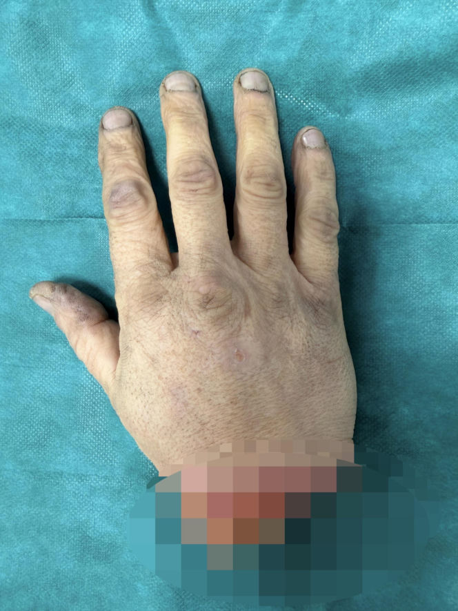 Wojciech Różycki stracił dłoń