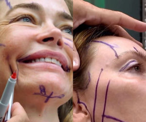 Denise Richards i jej lifting twarzy szokują. Aktorka się tłumaczy i pokazuje nagranie z zabiegu