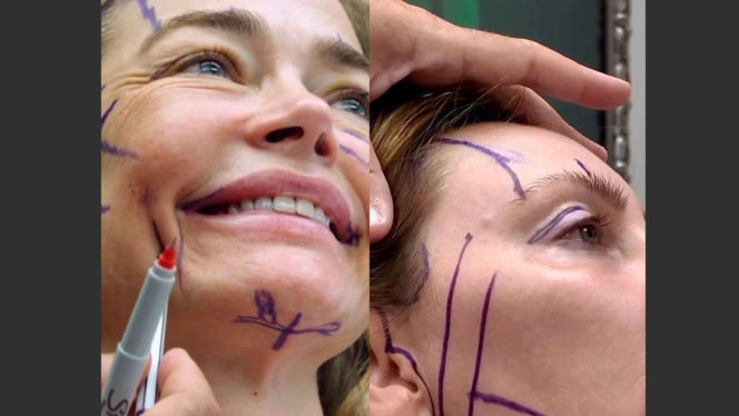 Denise Richards i jej lifting twarzy szokują. Aktorka się tłumaczy i pokazuje nagranie z zabiegu