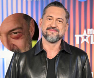 Marcin Prokop zdradza prawdę o podbitym oku po rozstaniu z żoną. Żarty się skończyły