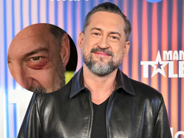 Marcin Prokop po rozstaniu pokazał podbite oko i rzucił niewybredny żart. Teraz powiedział, co naprawdę się stało