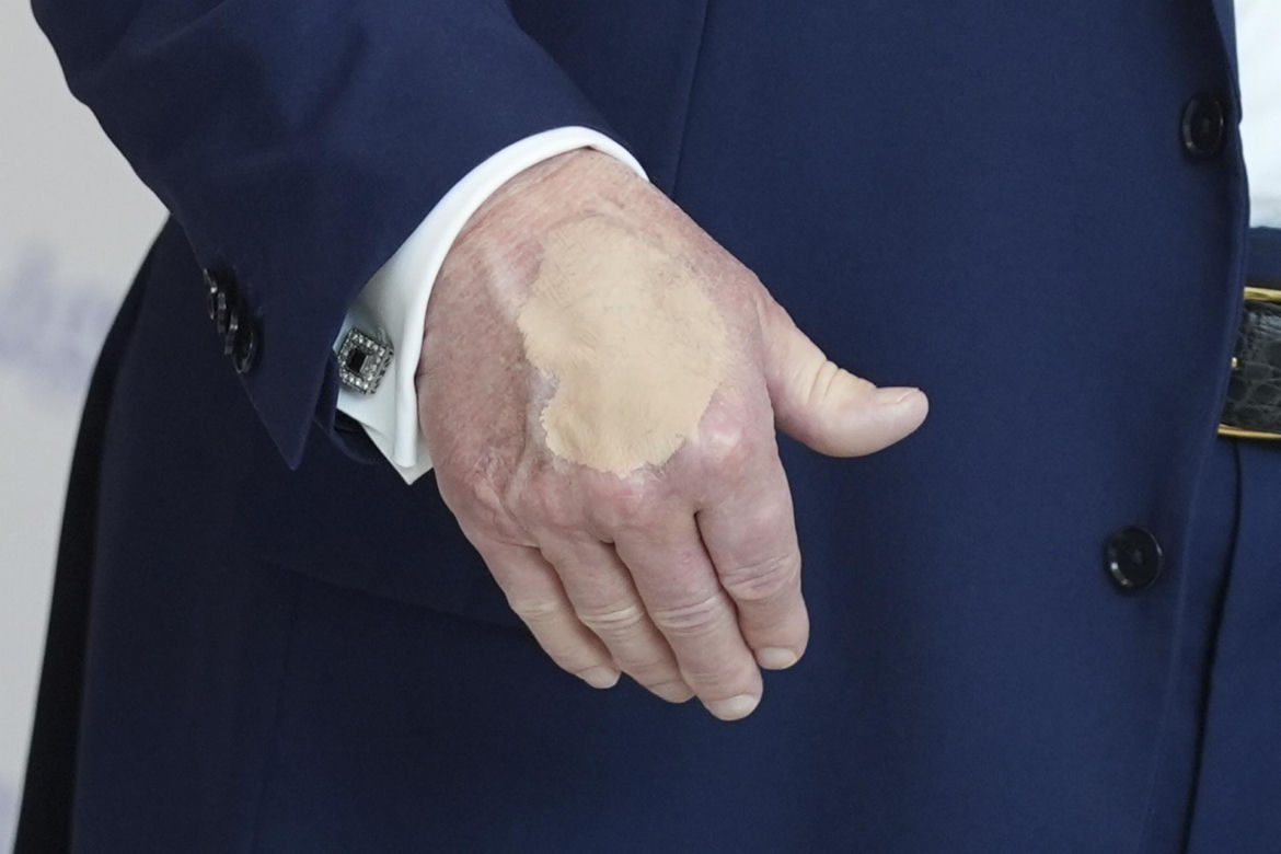Donald Trump ma kłopoty ze zdrowiem. Nowe zdjęcia wywołały niepokój
