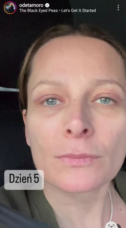 Odeta Moro wycięła sobie powieki