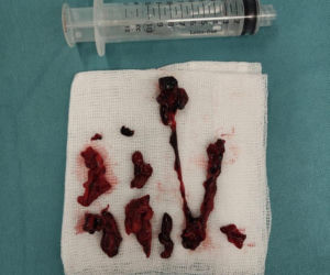 Pazurami wyrywaliśmy ją śmierci. Lekarze z Białegostoku cudem uratowali 36-letnią Justynę