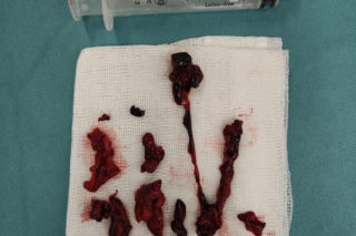 Pazurami wyrywaliśmy ją śmierci. Lekarze z Białegostoku cudem uratowali 36-letnią Justynę