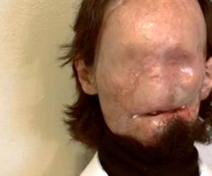 Dallas Weins przeszedł pierwszą na świecie pełną transplantację twarzy
