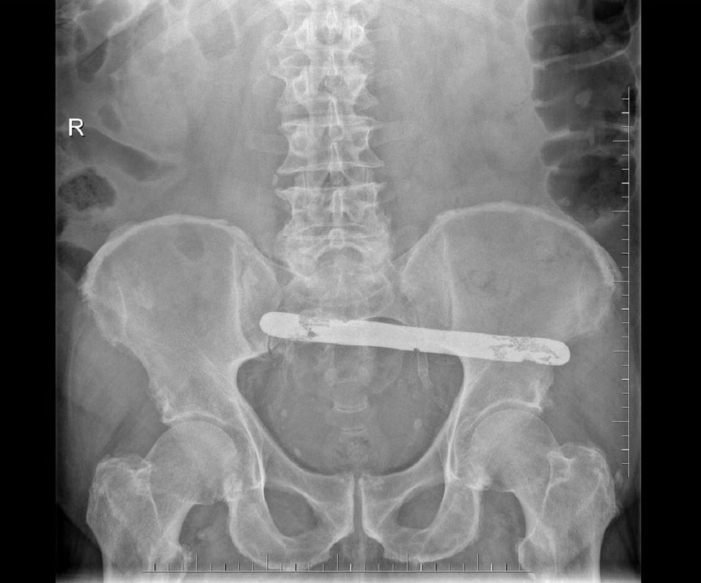 Podkarpackie. Przez 1,5 roku miał w brzuchu metalową szpatułkę długą na 19 cm! Została  po operacji