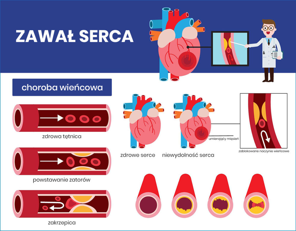 Jak dochodzi do zawału serca?