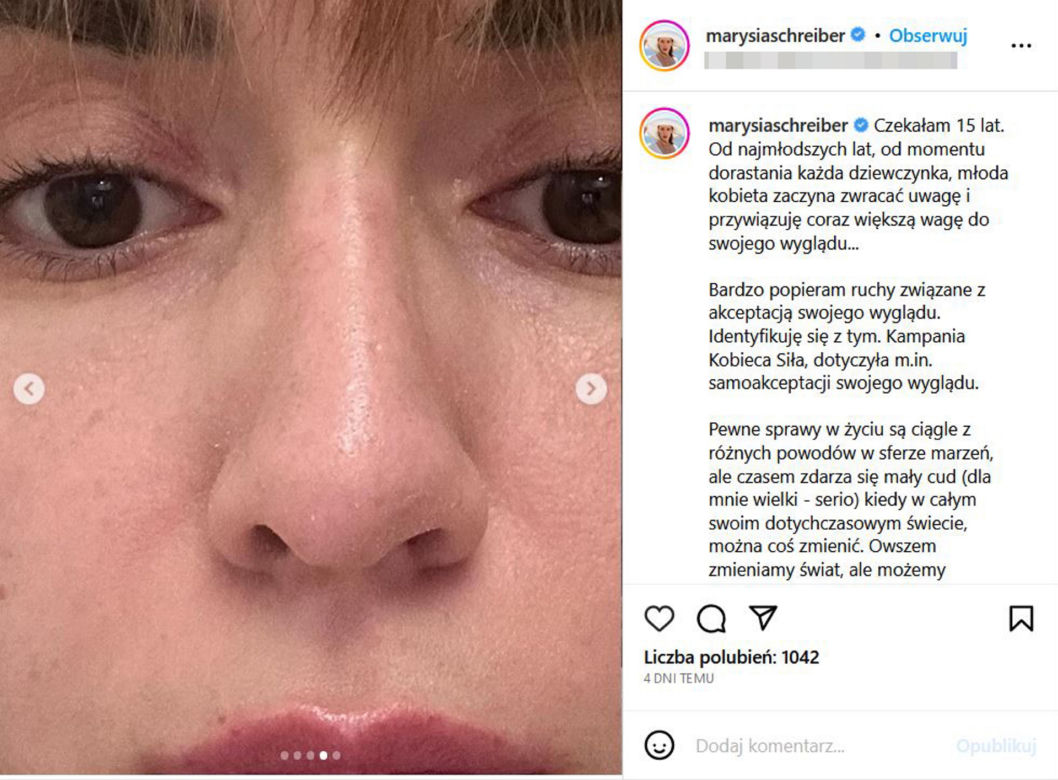 Tak wygląda Marianna Schreiber po operacji nosa