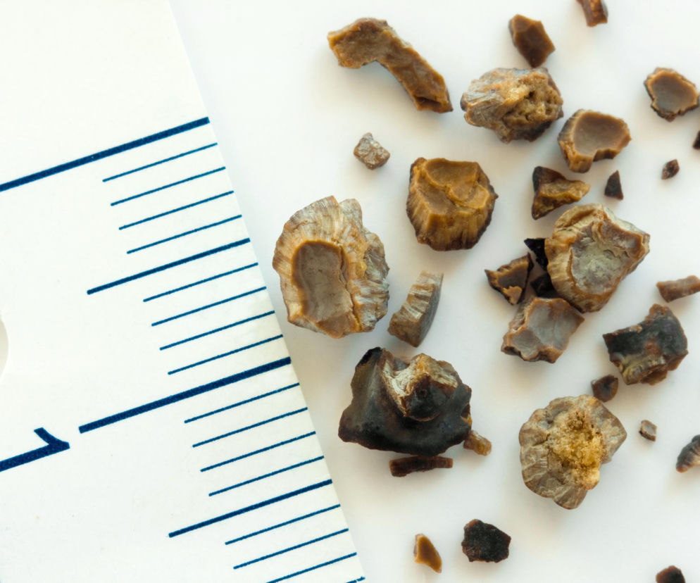 Kamienie nerkowe w różnych rozmiarach i kształtach, od jasnobrązowych po ciemniejsze, leżące obok linijki medycznej, która pomaga w ocenie ich wielkości. Więcej o profilaktyce kamicy przeczytasz na Poradnik Zdrowie.