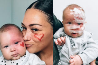 Jesteś potworem. Mama laserowo usunęła znamię u niemowlęcia, wylał się na nią hejt