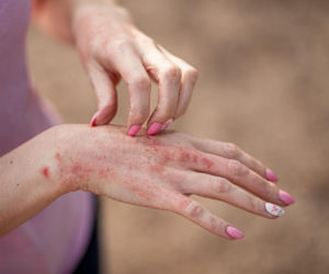 Egzema a stres. Naukowcy odkryli mechanizm, który wywołuje zaostrzenia objawów