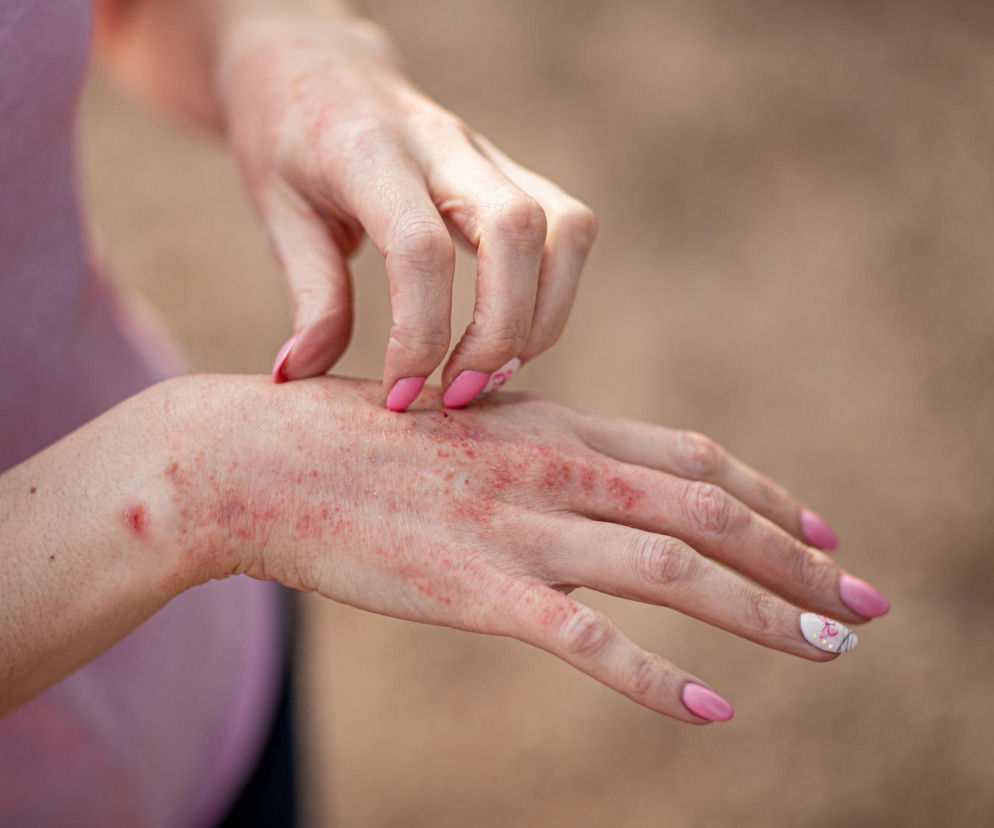 Dłonie kobiety z wyraźnymi zmianami skórnymi, zaczerwienieniem i suchością, co sugeruje egzemę. Jedna dłoń drapie drugą, odzwierciedlając uporczywy świąd towarzyszący atopowemu zapaleniu skóry, o czym więcej przeczytasz na Poradnik Zdrowie.