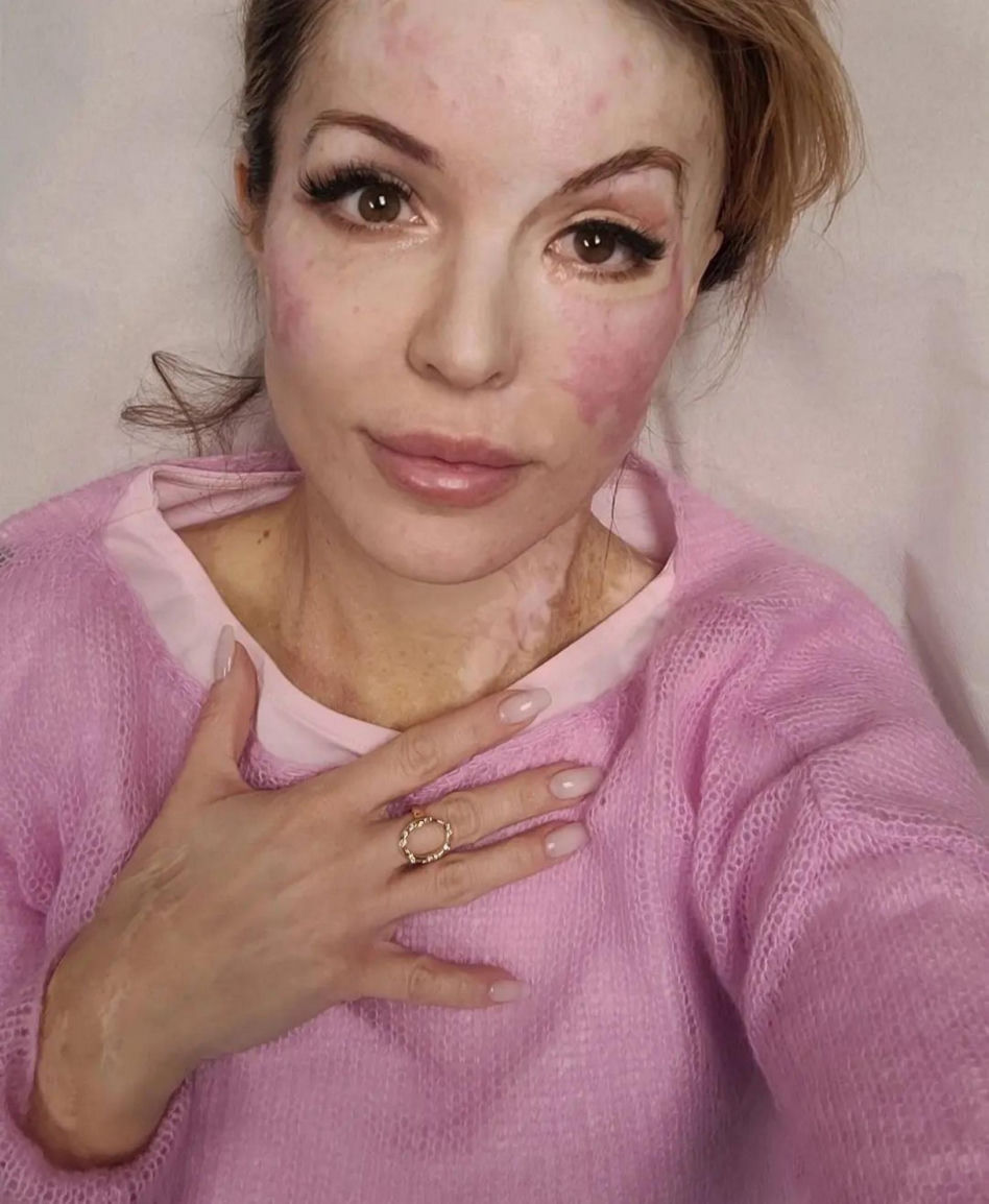 Oblali je twarz kwase. Tak wygląda modelka Katarzyna Dacyszyn po siedmiu latach