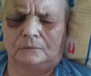 Śląskie. KOSZMAR pacjentki w szpitalach? Miała siniaki i krwiaki [DRASTYCZNE ZDJĘCIA]