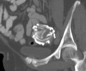 Przypadki „dzieci z kamienia” opisywano już w X wieku