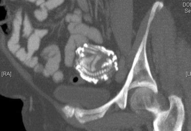 Przypadki „dzieci z kamienia” opisywano już w X wieku