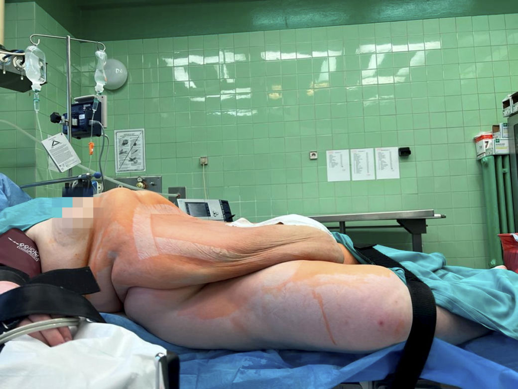 Wycięli pacjentce 100 kg guza