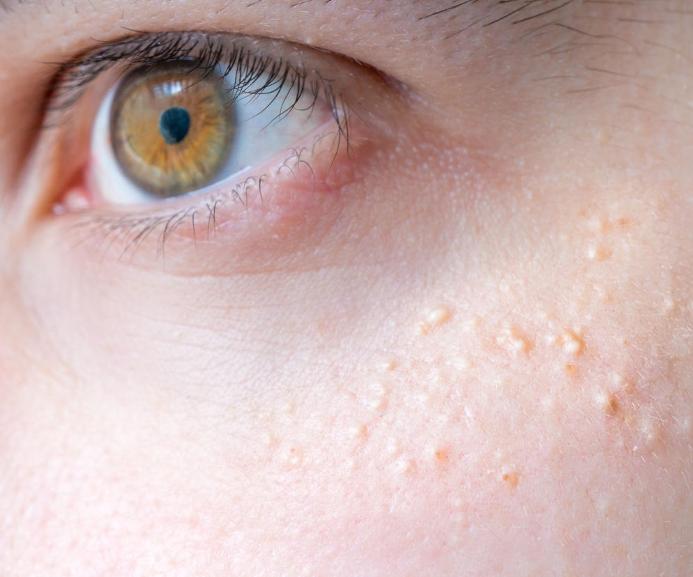 Białe grudki pod oczami to nie pryszcze. To mogą być prosaki, których nie powinno się samodzielnie wyciskać