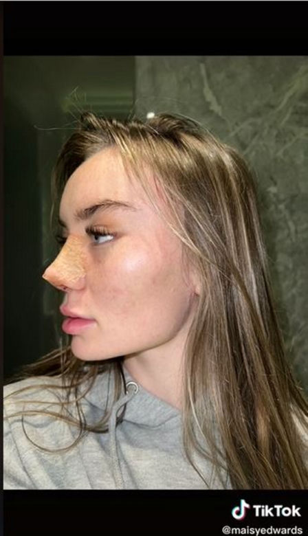 Znana influencerka pojechała do Turcji "zrobić" sobie nos. Wydała 50 tys. zł, fani bezlitośni: "Jest gorzej"
