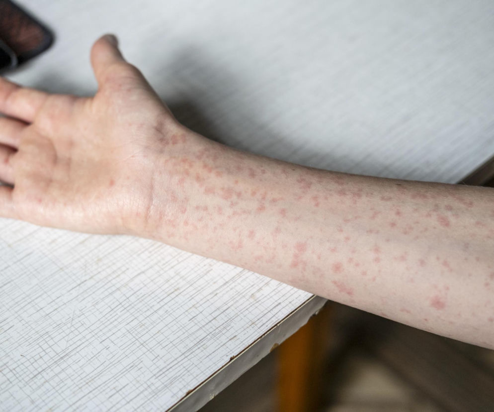 Ramię i dłoń z licznymi, czerwonymi, drobnymi plamkami, charakterystycznymi dla wysypki odrowej. Skóra jest zaczerwieniona i podrażniona, co ilustruje objawy odry, o której przeczytasz więcej na Poradnik Zdrowie.