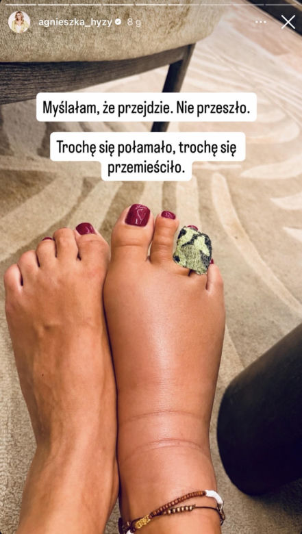 Agnieszka Hyży miała odpoczywać. Nagle doszło do bolesnego wypadku!