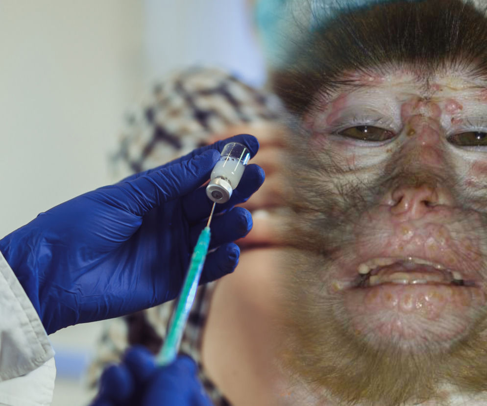 Małpia ospa w natarciu. Rozprzestrzenia się błyskawicznie. Grozi nam epidemia?