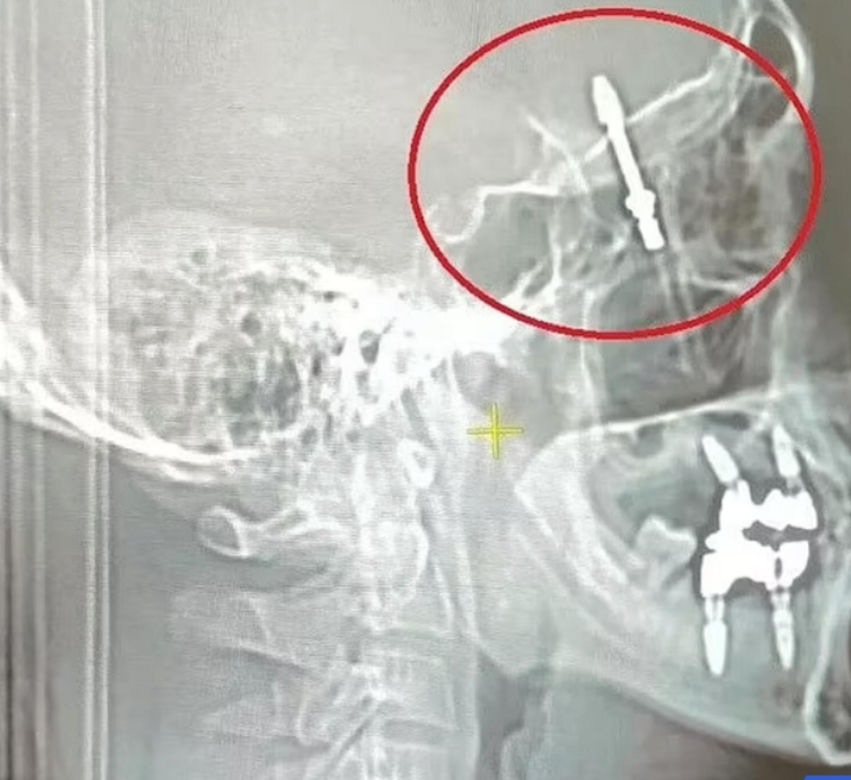 Dentysta wkręcił mi śrubę w mózg! "Zostawił mnie w szpitalu i uciekł"