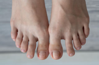 Nie ignoruj takich zmian na stopach. Mogą wskazywać na cukrzycę i problemy z krążeniem