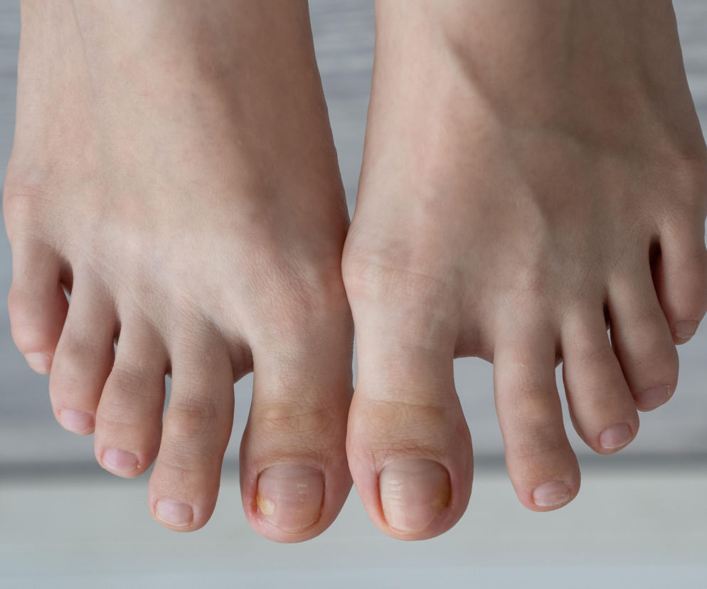 Dwie stopy z widocznymi zmianami na paznokciach dużych palców, które mogą świadczyć o problemach zdrowotnych, takich jak cukrzyca czy zaburzenia krążenia. Więcej o objawach na stopach, które powinny zaniepokoić, przeczytasz na Poradnik Zdrowie.