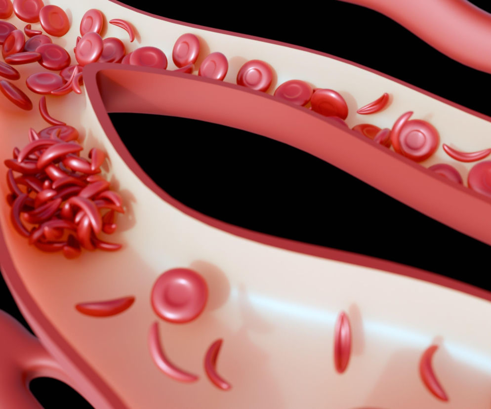 Czerwone krwinki o prawidłowym kształcie i sierpowate komórki krwi w naczyniu krwionośnym, obrazujące problem uszkodzenia naczyń mimo cukru w normie, o czym przeczytasz na Poradnik Zdrowie.