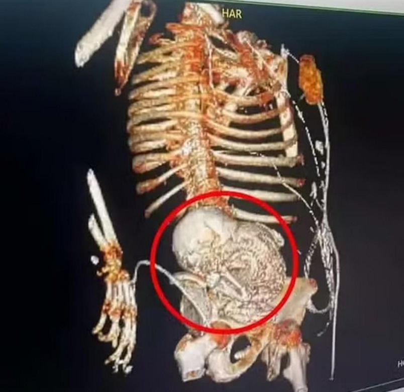 81-latka w ciąży! Umarła podczas wycinania płodu z brzucha