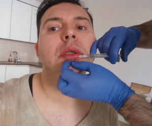 Michał Witkowski wstrzykuje sobie botoks i powiększa usta!