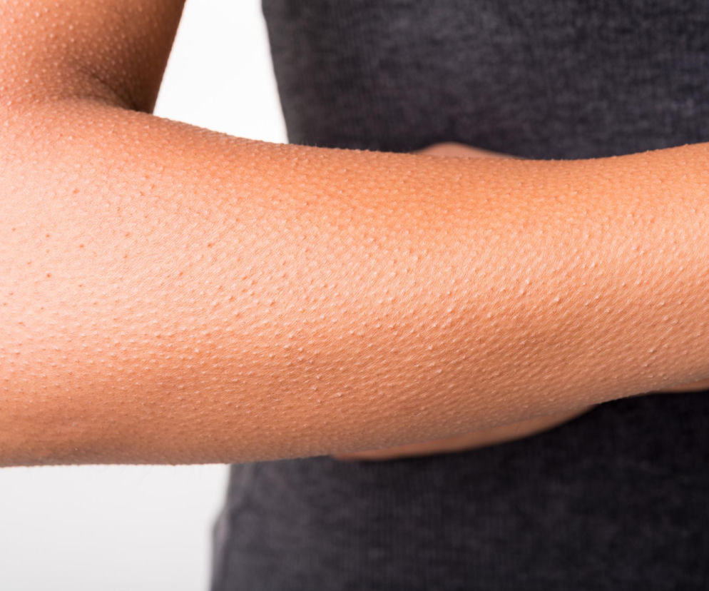 Piloerekcja na przedramieniu osoby w szarym ubraniu, widoczna jako liczne uniesione grudki na skórze, symbolizująca gęsią skórkę. Reakcja ta, nie tylko na zimno, może zdradzać cechy osobowości, o czym przeczytasz na portalu Poradnik Zdrowie.