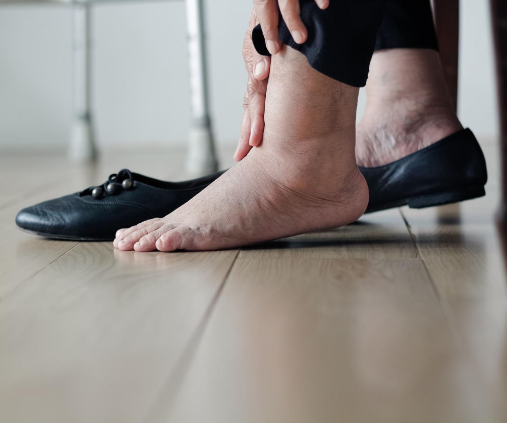 Puchną ci nogi? To może wcale nie być wina pogody. Lekarze: to ciastowaty objaw chorego narządu