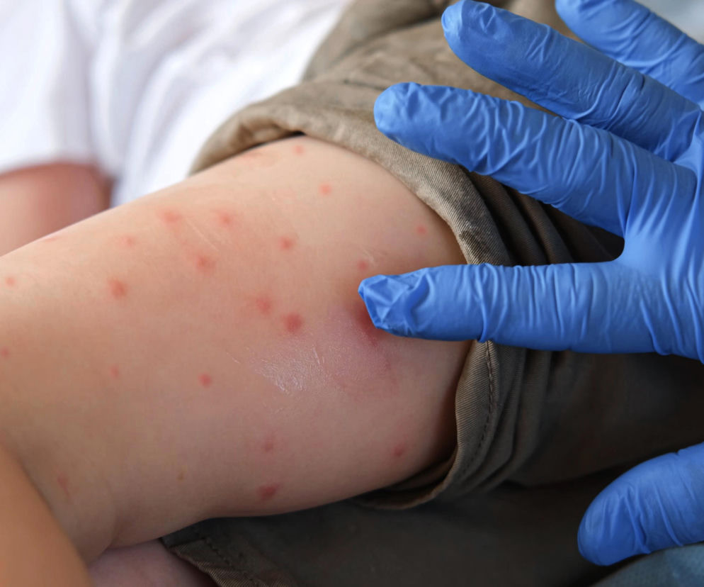 Dłoń w niebieskiej rękawiczce lekarskiej delikatnie dotykająca ramienia dziecka pokrytego czerwoną wysypką, symbolizująca diagnostykę odry. O tym, co zrobić, gdy miałeś styczność z wirusem, przeczytasz na Poradnik Zdrowie.