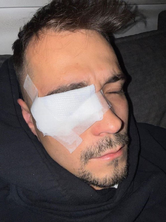 Polski influencer miał wypadek. Ucierpiało jego oko