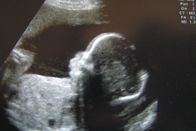 Choroby genetyczne. Czy aborcja jest możliwa w przypadku choroby genetycznej