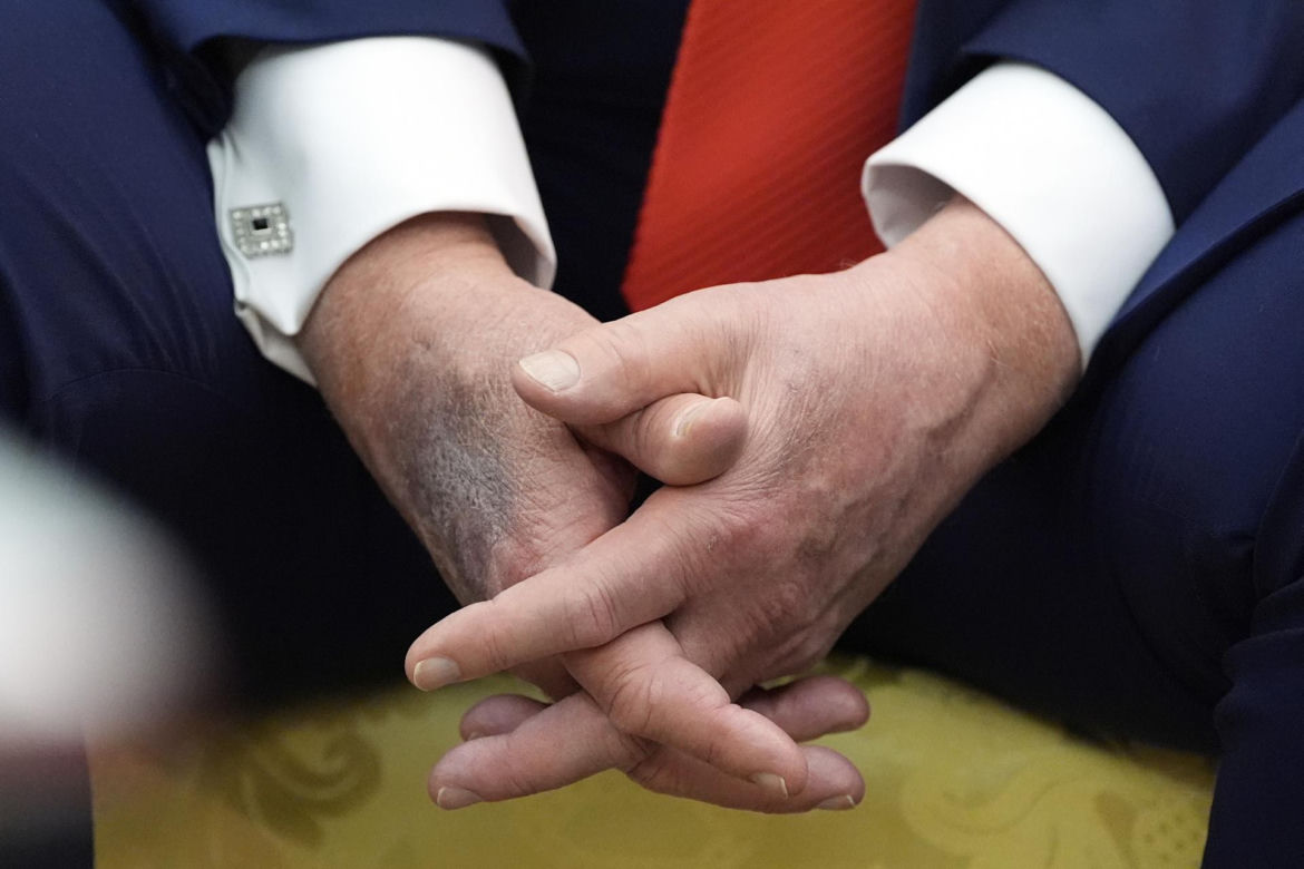 Donald Trump ma kłopoty ze zdrowiem. Nowe zdjęcia wywołały niepokój