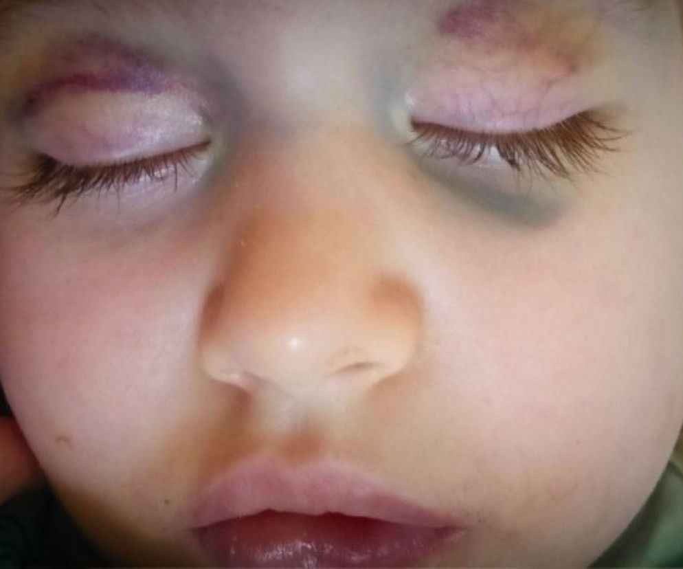 Zosia walczy z neuroblastomą. Rodzice sprzedali wszystko, by ją ratować