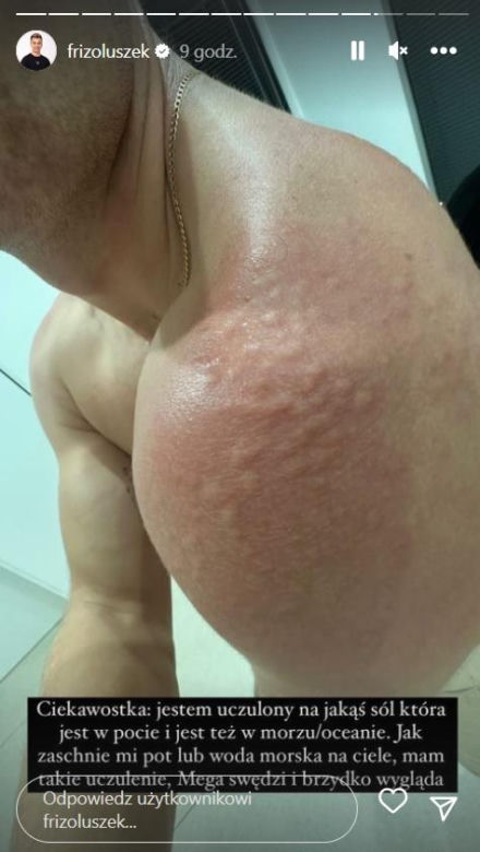 Friz na swoim InstaStories pokazał, że jest uczulony na słoną wodę!