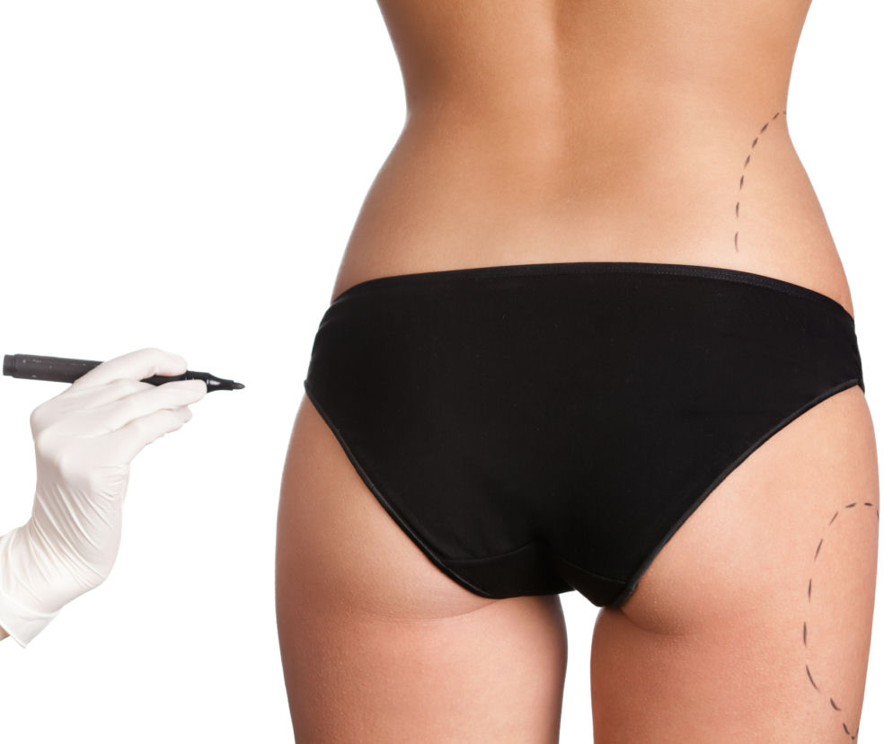 LIPOSUKCJA - odsysanie tłuszczu. Jak wygląda zabieg odchudzania i modelowania sylwetki?