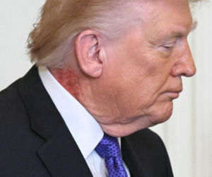 Czerwona plama na szyi Trumpa. Lekarz wyjaśnia, co dolega prezydentowi